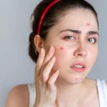 मुंहासों का इलाज अब घर पर, सिर्फ इन 3 चीजों से बनाएं असरदार फेस पैक