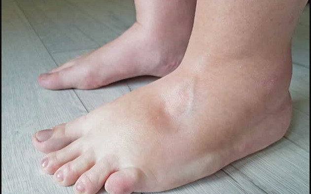 पैरों में बार-बार होने वाली सूजन को न करें नजरअंदाज, हो सकता है दिल की बीमारी का संकेत